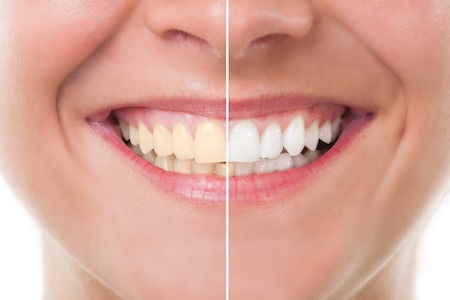 teeth whitening